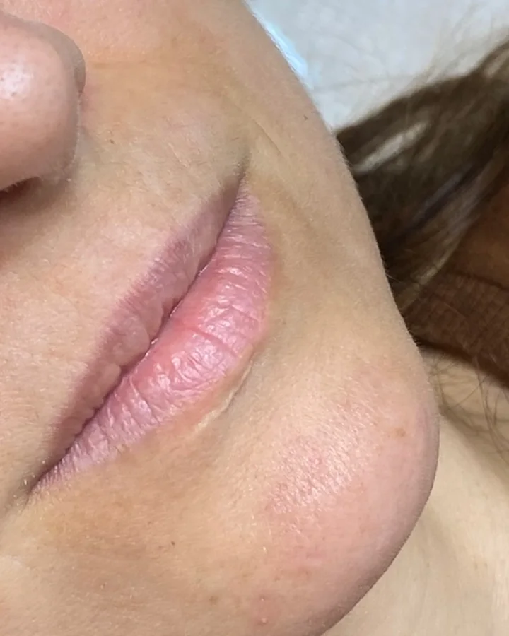 Lábios de uma paciente antes do preenchimento labial, em vista de perfil.