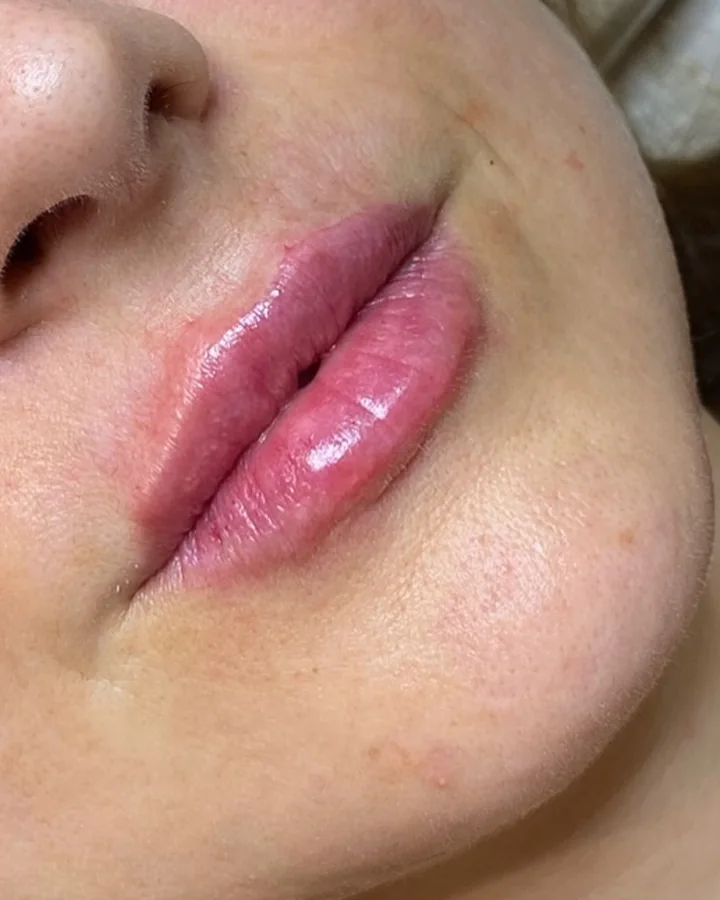 Os mesmos lábios depois do preenchimento labial, com mais volume e contorno definido.
