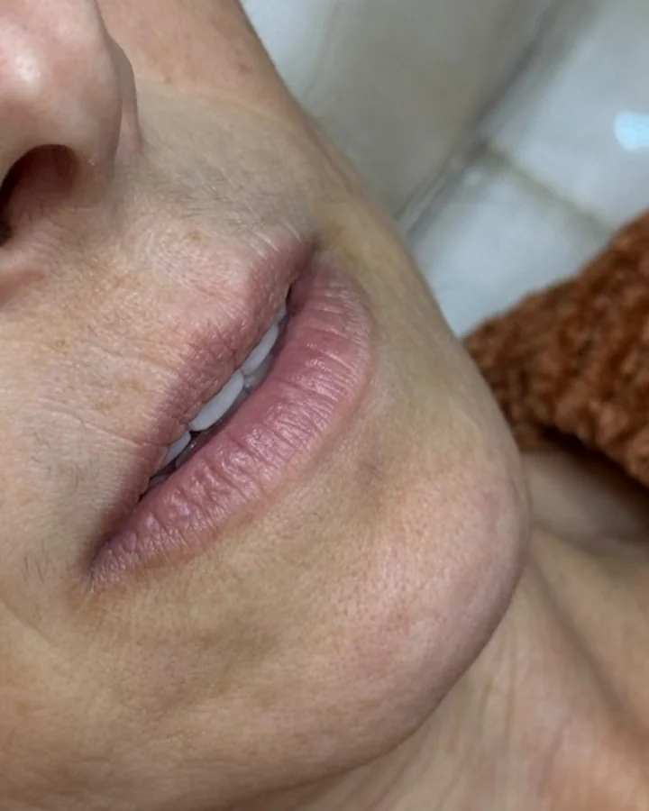 Lábios de outra paciente antes do preenchimento labial.