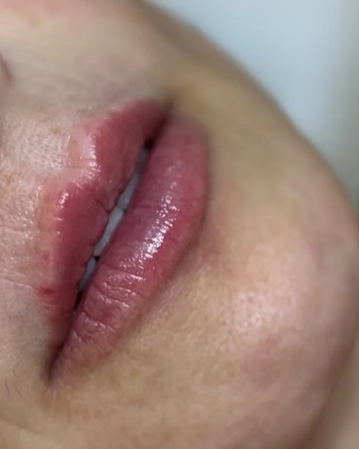 Os mesmos lábios depois do preenchimento labial, com contorno mais desenhado.