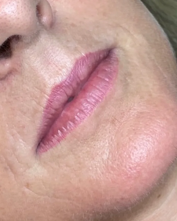 Lábios antes do preenchimento labial.