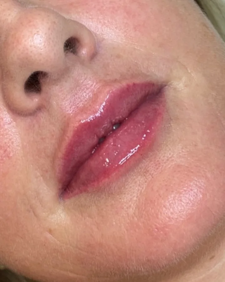 Os mesmos lábios depois do preenchimento labial.