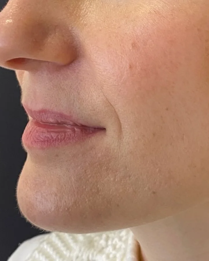 Lábios antes do preenchimento labial.
