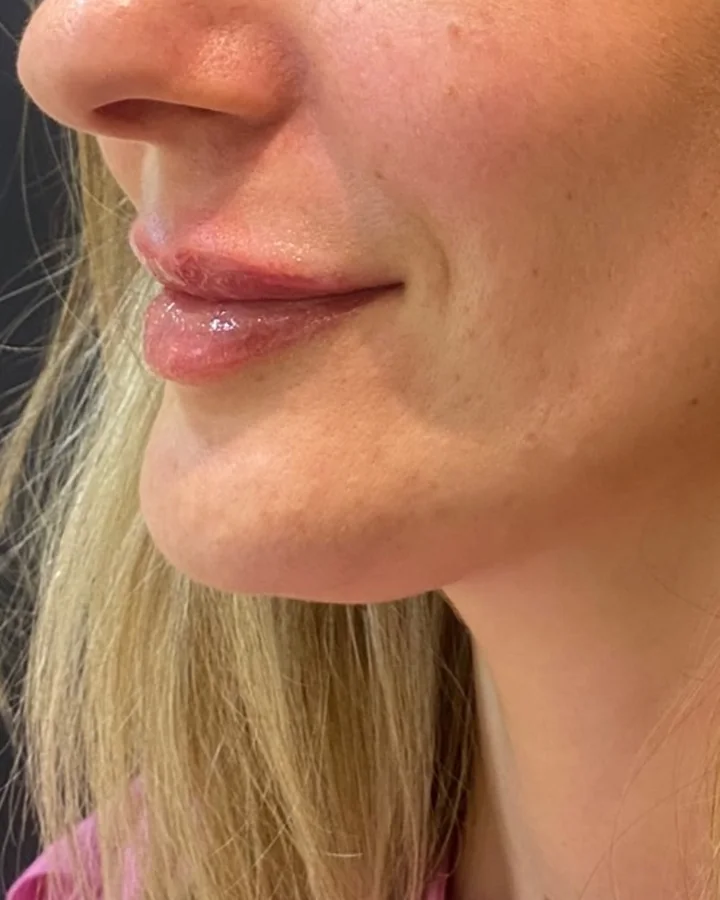 Os mesmos lábios depois do preenchimento labial.