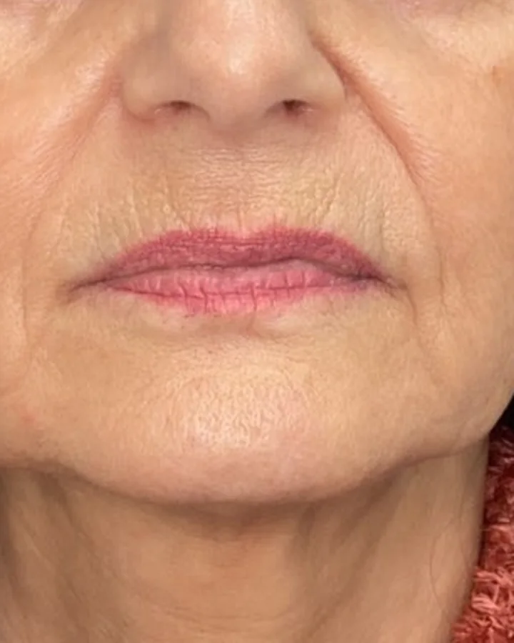 Lábios antes do preenchimento labial.