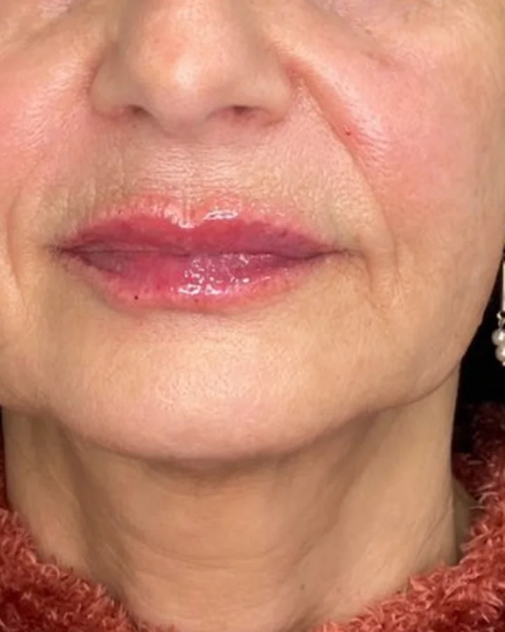 Os mesmos lábios depois do preenchimento labial.