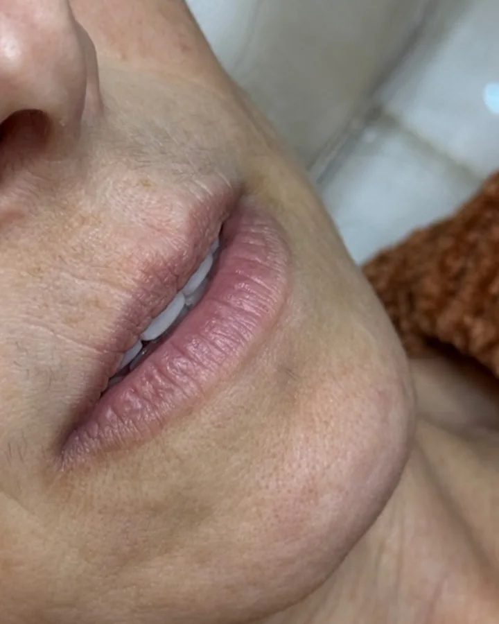 Lábios antes do preenchimento labial.
