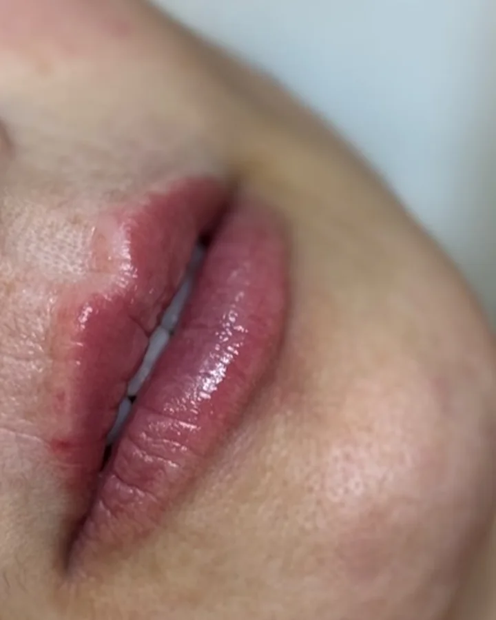 Os mesmos lábios depois do preenchimento labial.